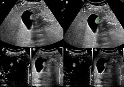 Preliminary study on diagnosis of gallbladder neoplastic polyps based on contrast-enhanced ultrasound and grey scale ultrasound radiomics